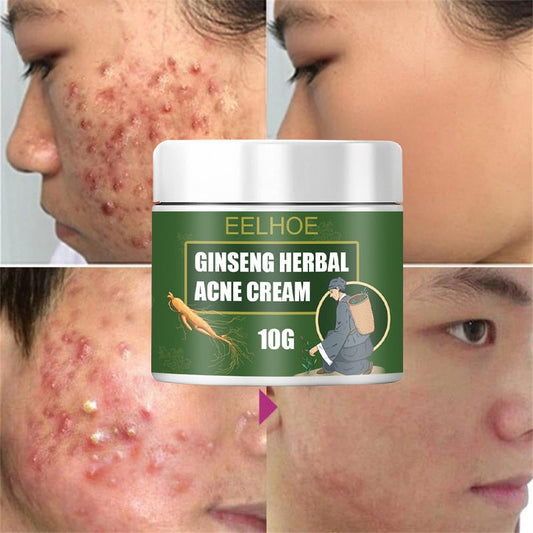 OHS beauty Acne Removal Cream Moisturizing Face Ginseng Acne Skin Care