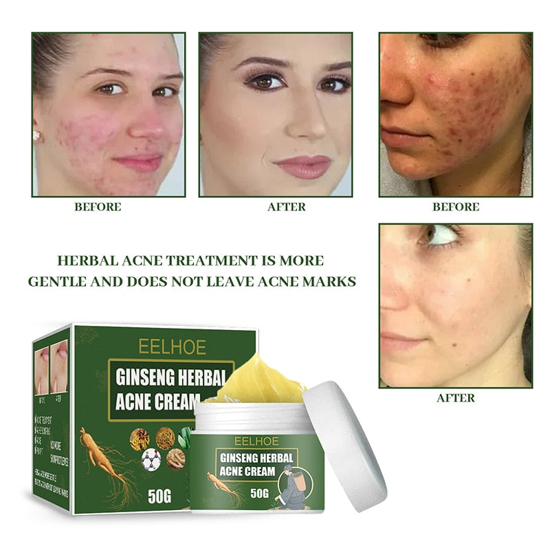 OHS beauty Acne Removal Cream Moisturizing Face Ginseng Acne Skin Care